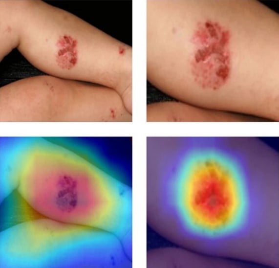 Figure 3 – An image of erythema localisation and detection by segmentation using CV (Son et al., 2021).