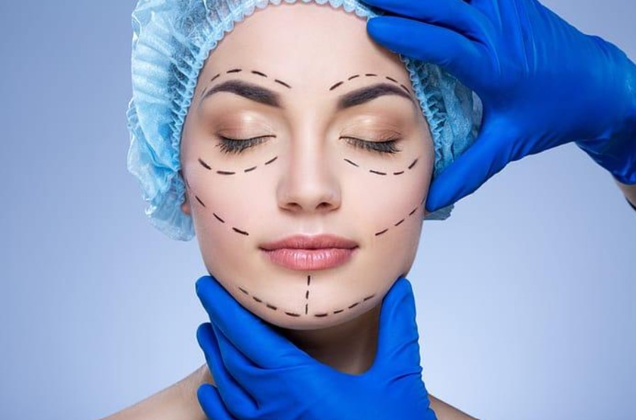 Figure 4 – A woman with lines drawn by the plastic surgeon as indicators of the sections that need to be made in surgery (Admin, 2024).