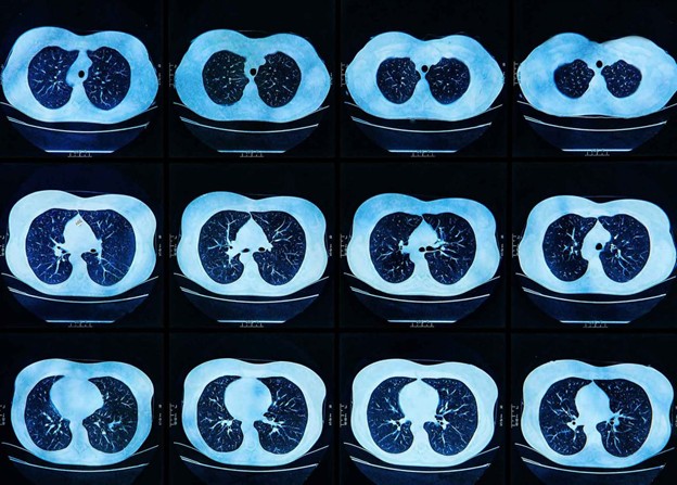 Figure 2 – An AI-powered solution to support chest CT imaging for patients with COVID-19 (Coronavirus) by RADLogics (Humphreys, 2020).